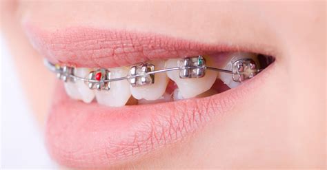 what happens if you swallow a metal bracket|swallowed rubber band from braces.